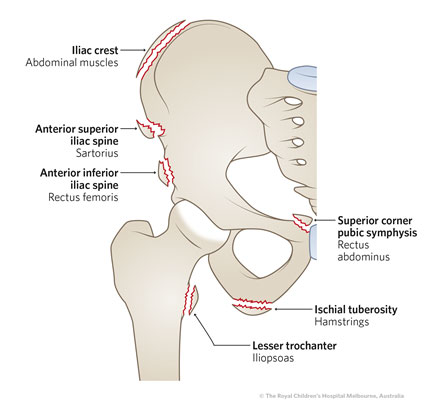 Clinical Practice Guidelines : Pelvic Avulsion Injuries