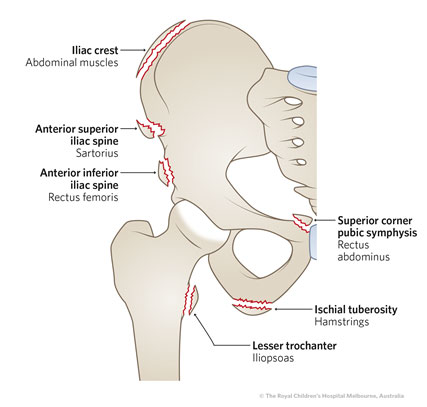 Clinical Practice Guidelines : Pelvic Avulsion Injuries – Emergency  Department