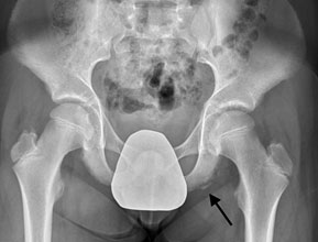 Ischial Tuberosity Fracture - Left