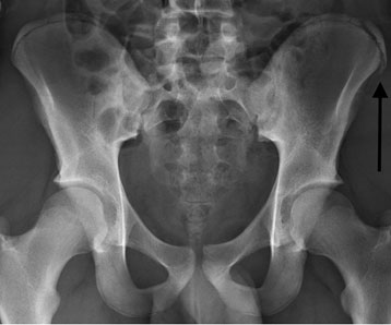  Avulsion of left iliac crest apophysis: sudden onset pain during sprinting in a 15 yo boy