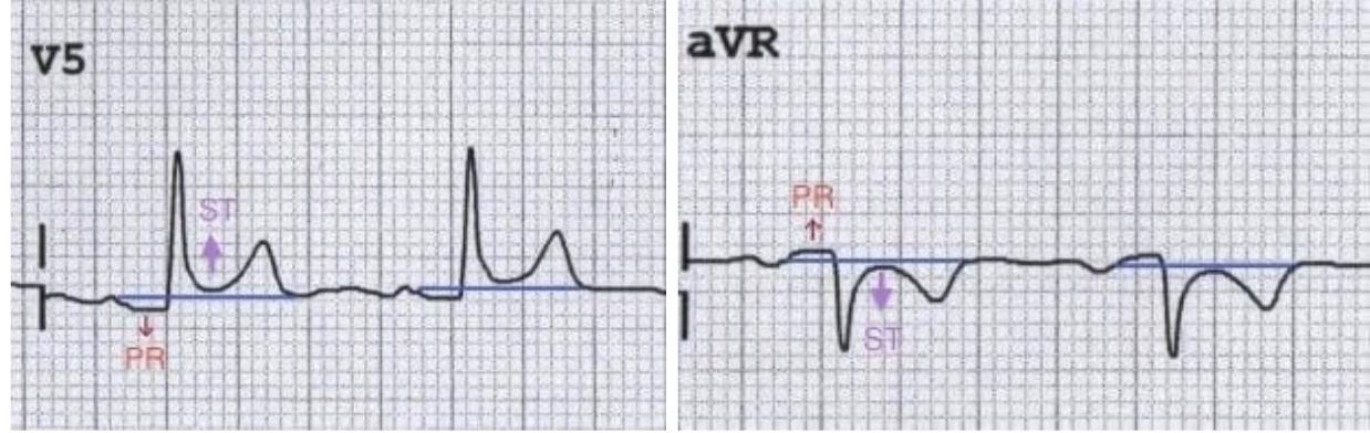 Pericarditis