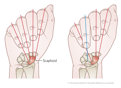 Phalangeal_image11