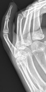 Phalangeal_image17