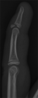 Phalangeal_image2