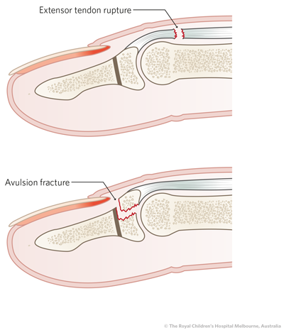 Phalangeal_image20