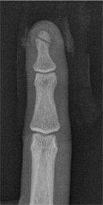 Phalangeal_image3