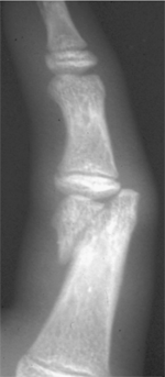 Phalangeal_image4