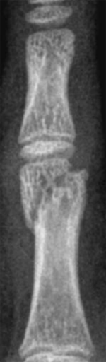 Phalangeal_image5