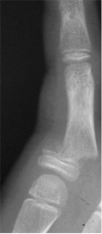 Phalangeal_image9