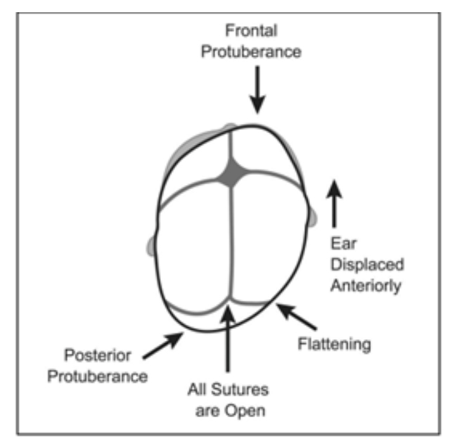 Positional-plagiocephaly-3