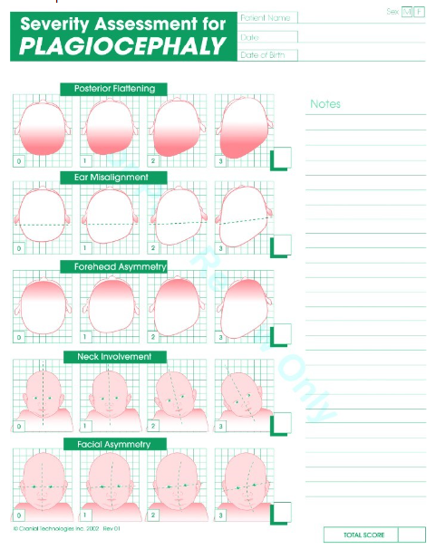 Positional plagiocephaly image 5