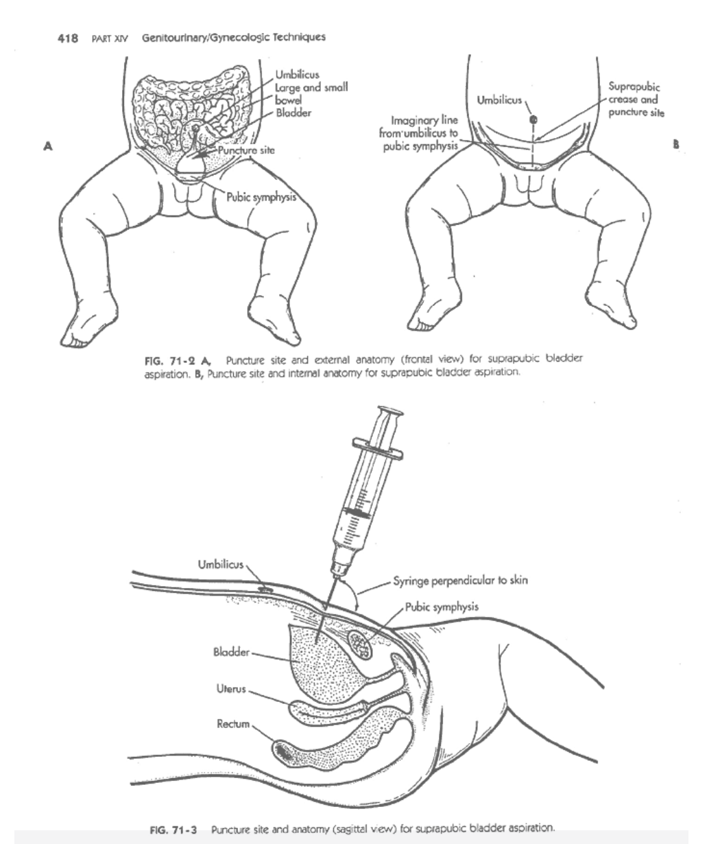 Positioning-of-infant-during-the-procedure
