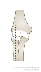 Radialneck_figure_3_radius_capitellum_line_ap.jpg