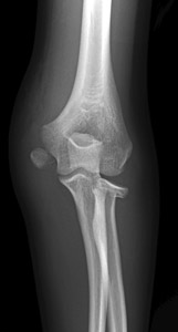 Radialneck_figure_4_elbow_shi_left_ap.jpg