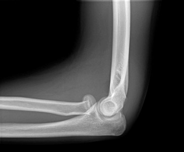 Radialneck_figure_4_elbow_shi_left_lat.jpg