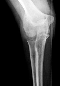 radial head fracture pain after 6 weeks