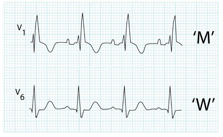 Right-BBB-RBBB Right-BBB-RBBB