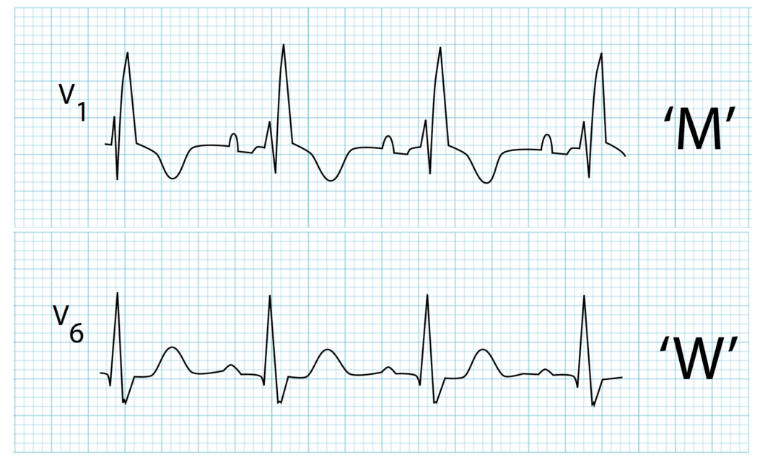 Right-BBB-RBBB