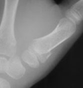 Fracture through an open physis