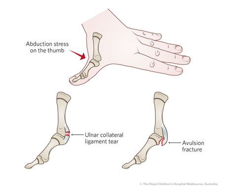 Radial Collateral Ligament Injuries
