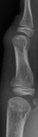 Fracture through physeal plate of proximal phalanx