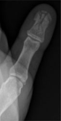 Distal Phalanx Tuft Fracture