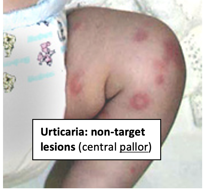 Urticaria