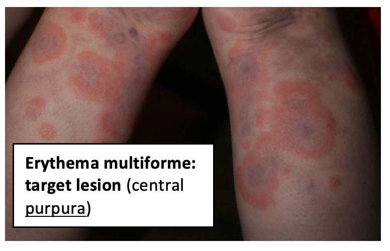 Erythema