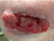 Wound-assessment-and-dressing-Picture5