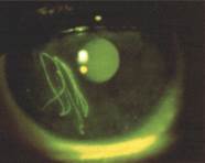 Linear corneal abrasions suggestive of a subtarsal FB