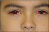 Case In Point: Subconjunctival Hemorrhages in a Teenage Boy | Consultant360