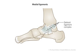 deltoid ligament ankle sprain