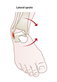 Combination of ankle inversion and external rotation