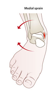 Forced plantar-flexion and eversion