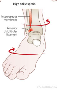 Forced dorsiflexion with eversion and external rotation