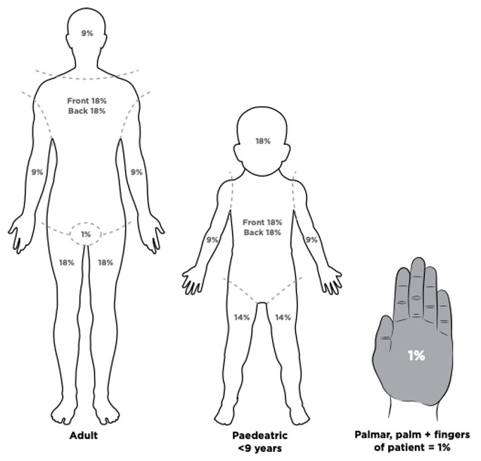 Burns - the palmar surface 