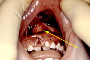 dental_trauma11