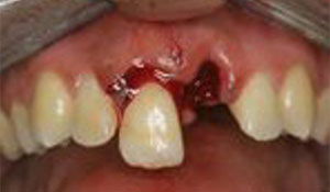 dental_trauma3