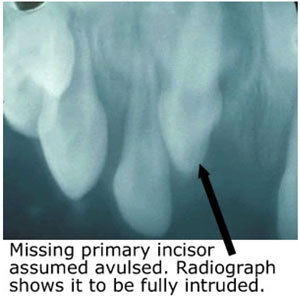 dental_trauma5