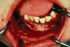 dental_trauma9