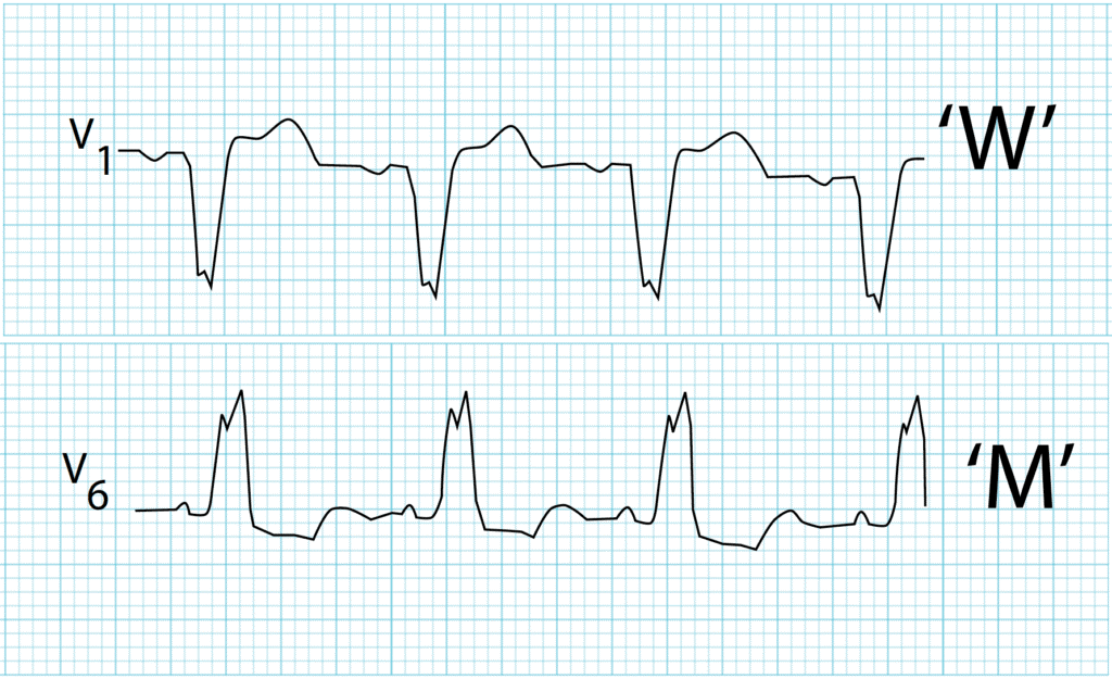 ECG image 3