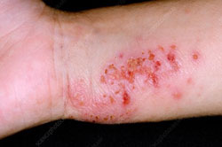 Eczema bacterial infection