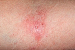 Eczema coxasackium