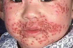 Eczema herpeticum