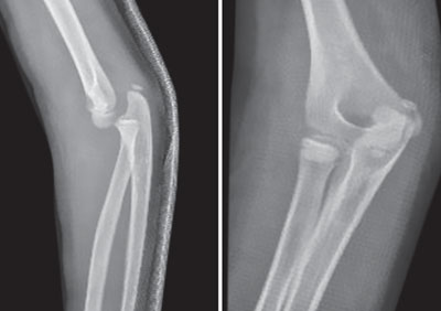 A case of bilateral elbow dislocation in a patient with Rubinstein