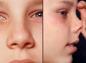 Allergic facies showing characteristic features