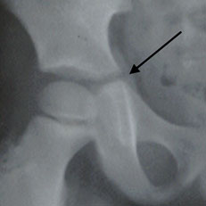 Open triradiate cartilage