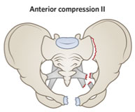 Gross pubic symphysis widening and anterior sacroiliac joint diastasis