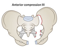 Disruption of posterior and anterior sacroiliac ligaments