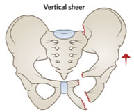 Complete disruption of SI joint and anterior ring fracture